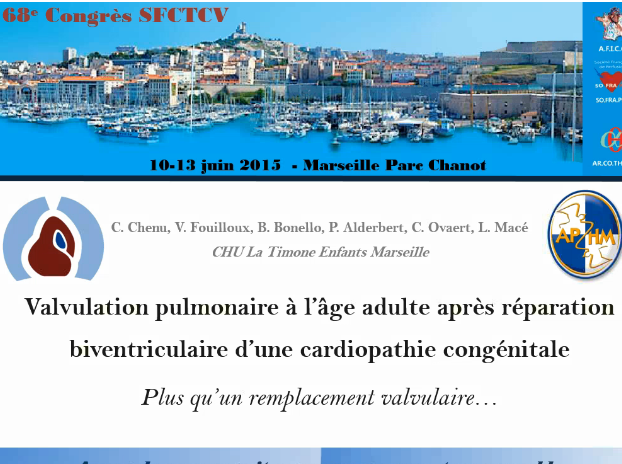 Valvulation pulmonaire l'age adulte après réparation ventriculaire d'une cardiopathie congénitale Valvulation pulmonaire l'age adulte après réparation ventriculaire d'une cardiopathie congénitale
