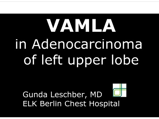 VAMLA dans l'adénocarninome du lobe supérieur gauche