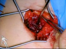 Vascular Collagen Plug Retrieval from Common Femoral Artery Vascular Collagen Plug Retrieval from Common Femoral Artery