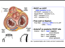 Ventricular tachycardia localisation by ECG