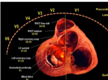 Ventricular tachycardia localization Using 12 lead ECG