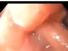 Vertical Banded Gastroplasty with Partial Outlet Obsctuction and Gastritis