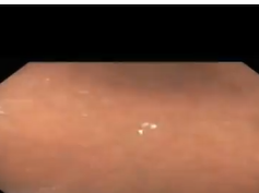 Vertical Banded Gastroplasty