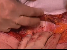 Vertical Rectus Abdominis Myocutaneous (VRAM) Flap after APR for Rectal Cancer Vertical Rectus Abdominis Myocutaneous (VRAM) Flap after APR for Rectal Cancer
