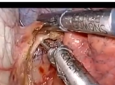 Video Presentation Of Thoracoscopic Vagotomy