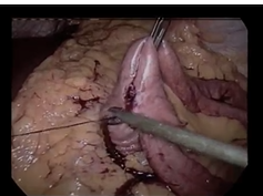 Video Symposium: Laparoscopic Bowel Repair- Help, There's a Hole in the Bowel! Video Symposium: Laparoscopic Bowel Repair- Help, There's a Hole in the Bowel!