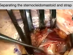 Videoassisted Parathyroidectomy Using the Focused Lateral Approach