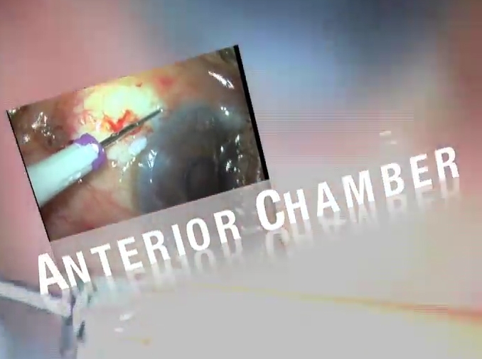 videousa/2016/2016-AAO/v03_2016_Trocar_Anterior_Chamber_Maintainer-Athiya_Agarwal.mp4 videousa/2016/2016-AAO/v03_2016_Trocar_Anterior_Chamber_Maintainer-Athiya_Agarwal.mp4