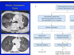 Virtual FTS Adult Session: Metaphorical Signs in Computed Tomography of Chest Virtual FTS Adult Session: Metaphorical Signs in Computed Tomography of Chest