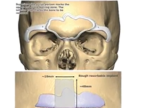 Virtual Planning for Facial Feminization. Plastic Surgery Hot Topics with Rod J. Rohrich, MD Virtual Planning for Facial Feminization. Plastic Surgery Hot Topics with Rod J. Rohrich, MD