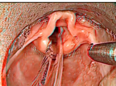 Visualization of the Supraglottis During Suprglottoplasty for Laryngomalacia Using 3D Endoscopy Visualization of the Supraglottis During Suprglottoplasty for Laryngomalacia Using 3D Endoscopy