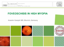 Troubles Vitréomaculaire - Le fovéoschisis en myopie avancée Troubles Vitréomaculaire - Le fovéoschisis en myopie avancée