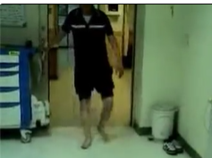 Waddling Gait Waddling Gait