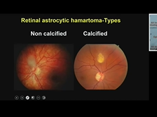 Webinar on Retinoblastoma in World retinoblastoma awareness week