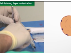 What is Mohs Surgery?