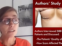 What Patients Think of Scars. Plastic Surgery Hot Topics with Drs. Rohrich and Pusic What Patients Think of Scars. Plastic Surgery Hot Topics with Drs. Rohrich and Pusic