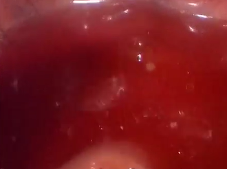 What To Do When the Air Test is Positive during Laparoscopic Rectal Cancer Excision What To Do When the Air Test is Positive during Laparoscopic Rectal Cancer Excision