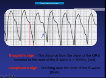 Wide complex tachycardia vs Vtach, differential diagnosis & management
