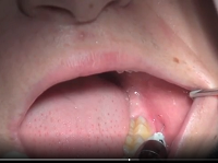 Wisdom tooth anesthesia