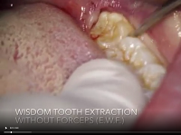 Wisdom tooth Extraction Without Forceps (E.W.F.)