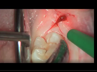 Wisdom tooth flap elevation