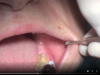 Wisdom tooth flap suture