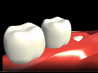 Wisdom tooth odontomy