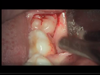 Wisdom tooth: osteotomy