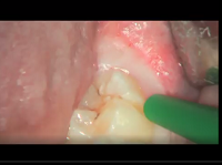 Wisdom tooth surgical flap design