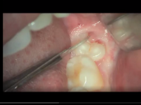 Wisdom tooth surgical flap incision