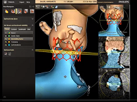Workshop 2 Aortic stenosis in the elderly
