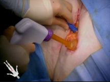 Wound Vac Placement Wound Vac Placement