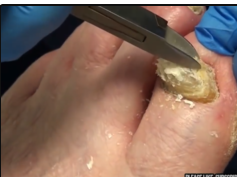 YouTube's Best Pops, Blackheads, Ingrown Nails & Zits - All Star Doctors!