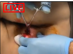 YouTube's First Live Abscess Removal & Treatment! (NSFE)